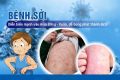 BÀI TUYÊN TRUYỀN VỀ  PHÒNG CHỐNG BỆNH SỞI